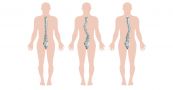 Bệnh cong vẹo cột sống - Triệu chứng, nguyên nhân và cách điều trị