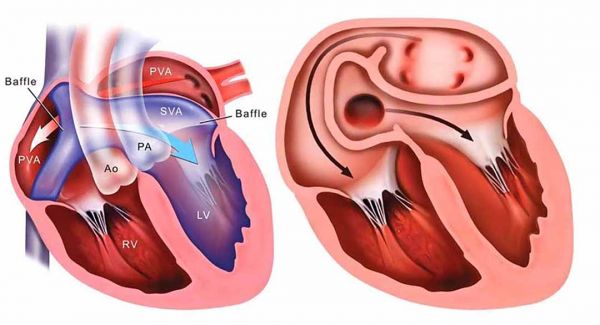 Chuyển vị các động mạch lớn - Triệu chứng, nguyên nhân và cách điều trị