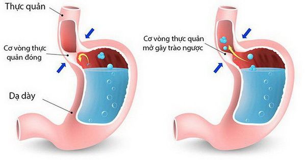 Bệnh co thắt tâm vị - Triệu chứng, nguyên nhân và cách điều trị