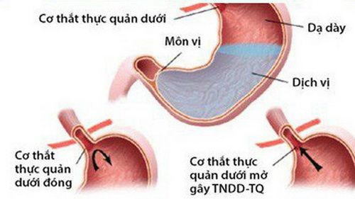 Bệnh co thắt thực quản - Triệu chứng, nguyên nhân và cách điều trị