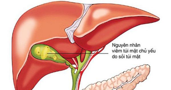 Cơn đau quặn mật - Triệu chứng, nguyên nhân và cách điều trị