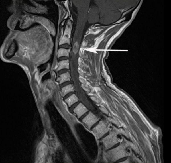 Chụp CT cột sống cổ - Quy trình thực hiện và những lưu ý cần biết