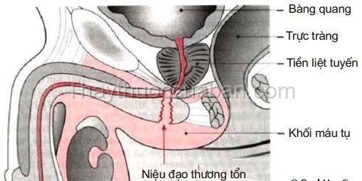 Bệnh chấn thương niệu đạo - Triệu chứng, nguyên nhân và cách điều trị
