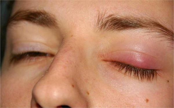 Bệnh chắp mắt - Triệu chứng, nguyên nhân và cách điều trị