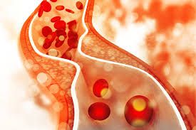 Bệnh cholesterol cao - Triệu chứng, nguyên nhân và cách điều trị