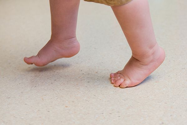 Chứng đi nhón chân ở trẻ - Triệu chứng, nguyên nhân và cách điều trị
