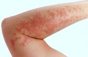 Bệnh bọng nước Pemphigoid - Triệu chứng, nguyên nhân và cách điều trị