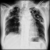 Bệnh bụi phổi silic - Triệu chứng, nguyên nhân và cách điều trị