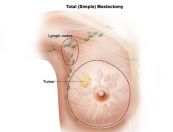 Bệnh bướu sợi tuyến - Triệu chứng, nguyên nhân và cách điều trị