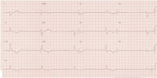 Bệnh block nhĩ thất cấp 3 - Triệu chứng, nguyên nhân và cách điều trị