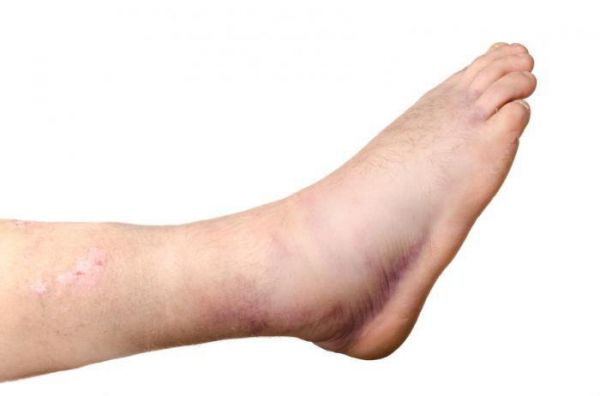 Bệnh bong gân cổ chân - Triệu chứng, nguyên nhân và cách điều trị