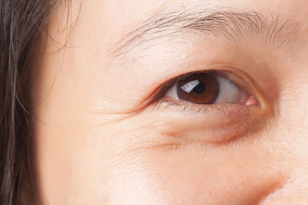 Chứng bọng mắt - Triệu chứng, nguyên nhân và cách điều trị
