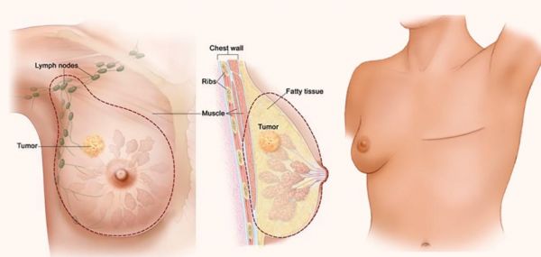 Cắt bỏ khối u vú - Những thông tin cần biết