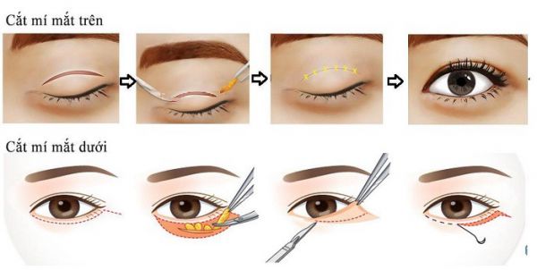 Phẫu thuật cắt mí mắt - Quy trình thực hiện và những lưu ý cần biết