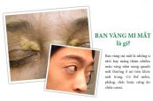 Bệnh ban vàng mí mắt - Triệu chứng, nguyên nhân và cách điều trị