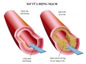 Bệnh xơ vữa động mạch - Triệu chứng, nguyên nhân và cách điều trị