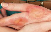 Hội chứng bỏng - Triệu chứng, nguyên nhân và cách điều trị
