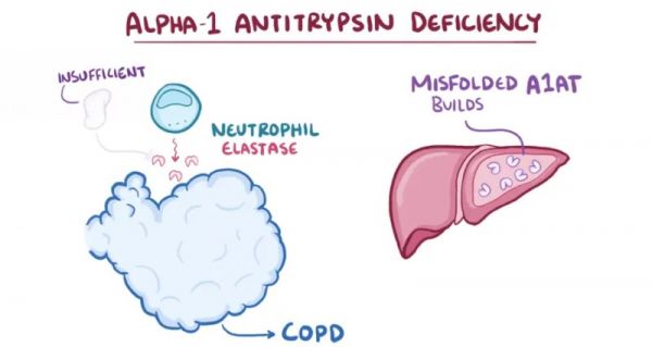 Xét nghiệm Alpha – 1 antitrypsin - Quy trình thực hiện và những lưu ý cần biết