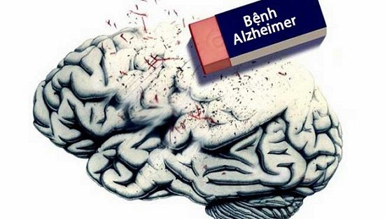Alzheimer - Triệu chứng, nguyên nhân và cách điều trị