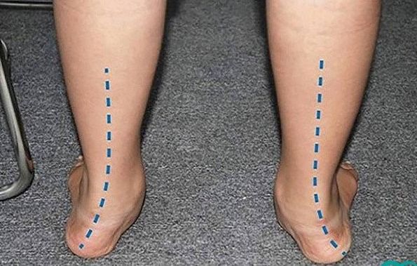 Hội chứng bàn chân bẹt - Triệu chứng, nguyên nhân và cách điều trị
