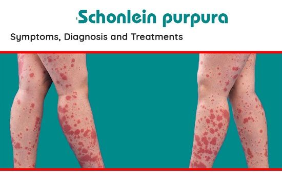 Bệnh henoch - Schonlein - Triệu chứng, nguyên nhân và cách điều trị