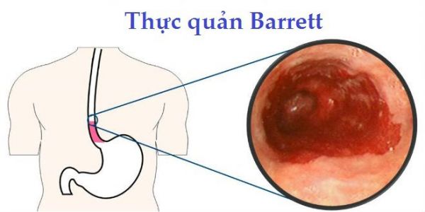 Bệnh Barrett thực quản - Triệu chứng, nguyên nhân và cách điều trị
