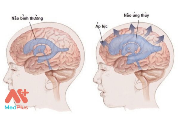 Bệnh Alexander: Triệu chứng, phòng ngừa và cách điều trị