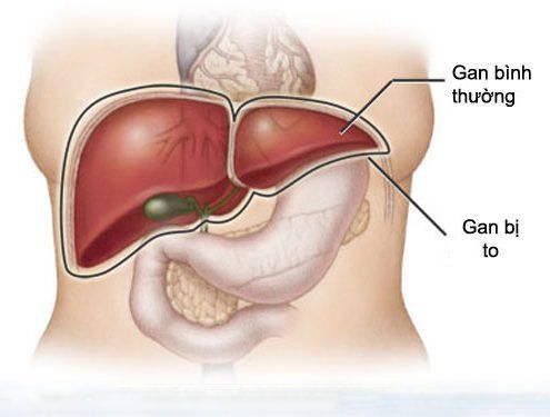 Bệnh gan to - Triệu chứng, nguyên nhân và cách điều trị