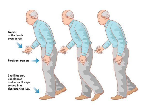 Bệnh Parkinson - Triệu chứng, nguyên nhân và cách điều trị