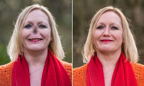 Bệnh u hạt Wegener - Triệu chứng, nguyên nhân và cách điều trị