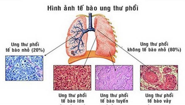 Bệnh ung thư phổi không tế bào nhỏ - Triệu chứng, nguyên nhân và cách điều trị