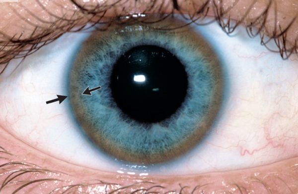 Bệnh Wilson - Triệu chứng, nguyên nhân và cách điều trị