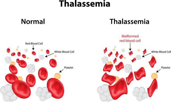 Bệnh beta thalassemia - Triệu chứng, nguyên nhân và cách điều trị