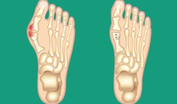 Bệnh biến dạng ngón chân cái - Triệu chứng, nguyên nhân và cách điều trị