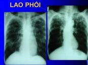 Lao phổi - Triệu chứng, nguyên nhân và cách điều trị