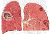 Bệnh phổi kẽ - Triệu chứng, nguyên nhân và cách điều trị