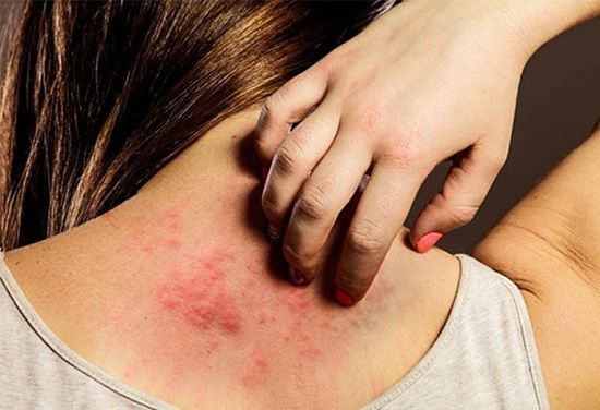 Bệnh phong - Triệu chứng, nguyên nhân và cách điều trị