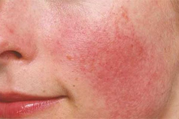 Các cách chăm sóc da mặt hiệu quả khi bị dị ứng mỹ phẩm